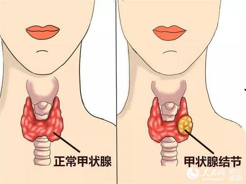 甲状腺结节可以吃秋瓜,甲状腺结节患者的饮食调养之道